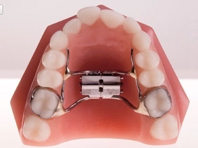 Expansor palatino-Dentistas de confianza